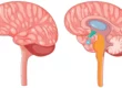 Cerebellopontine Angle Tumor