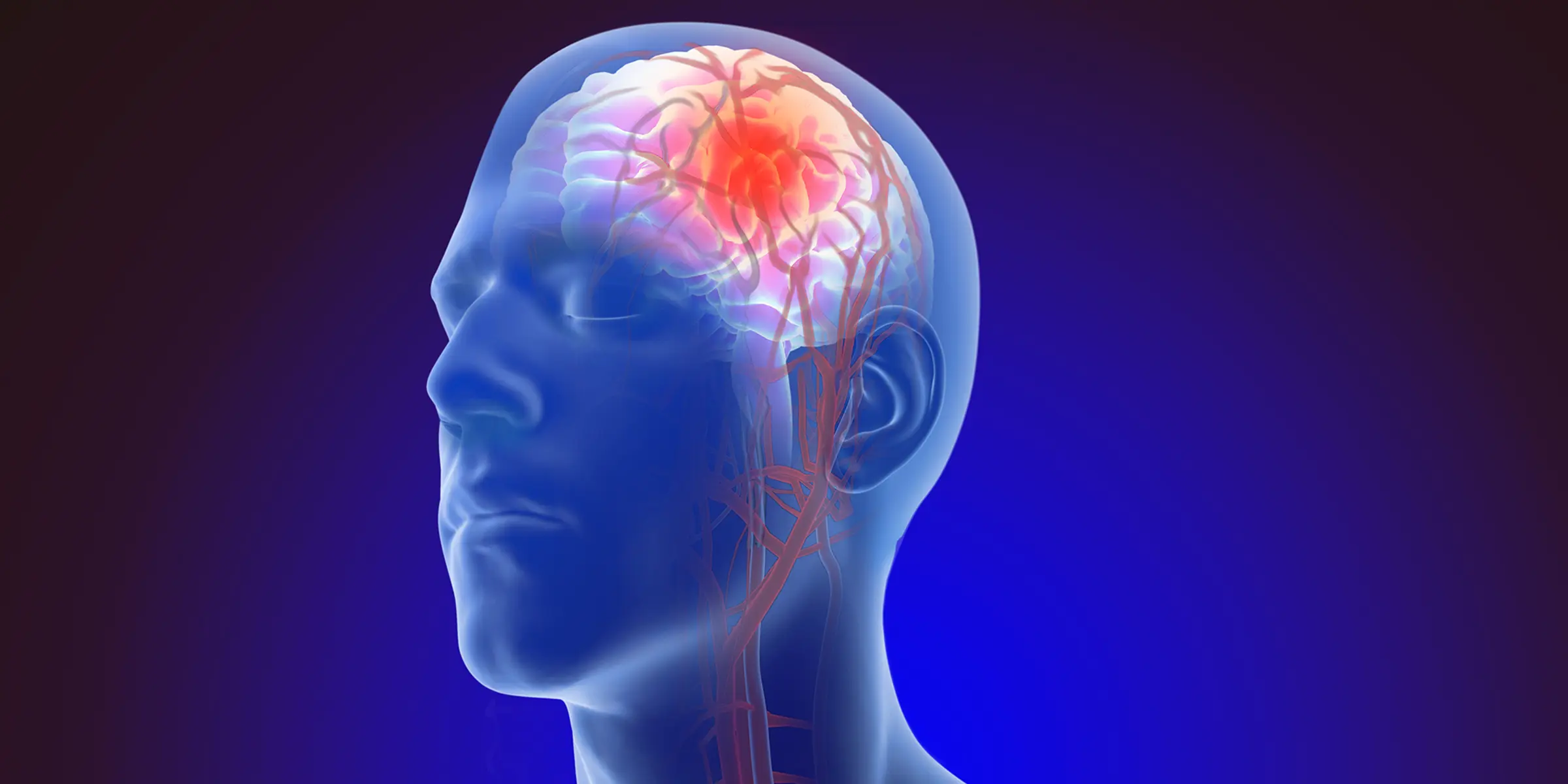 Cerebral Brain Anuerysm Cerebral Brain Anuerysm