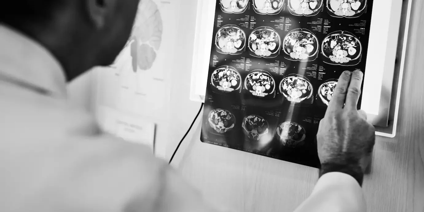 Intracranial Tuberculomas Intracranial Tuberculomas